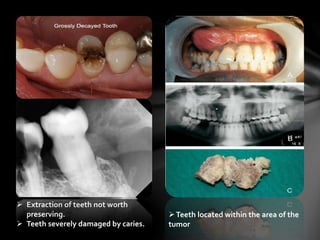 Teeth located within the area of the
tumor
 Extraction of teeth not worth
preserving.
 Teeth severely damaged by caries.
 