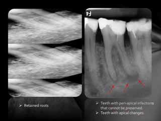  Retained roots
 Teeth with peri-apical infections
that cannot be preserved.
 Teeth with apical changes.
 