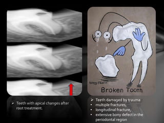  Teeth with apical changes after
root treatment.
 Teeth damaged by trauma
• multiple fractures,
• longitudinal fracture,
• extensive bony defect in the
periodontal region
 