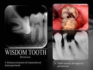  Teeth severely damaged by
periodontal
 Disease extraction of impacted and
dislocated teeth
 