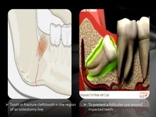  Tooth in fracture cleft/tooth in the region
of an osteotomy line
 To prevent a follicular cyst around
impacted teeth
 