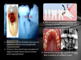  Risk of caries in adjacent teeth due to
crowded, partially impacted teeth which
cannot be cleaned adequately
 Resorption of the alveolar bone due to
repeated infection around partially
impacted teeth.
 If there is the risk of root resorption of
adjacent teeth due to direct contact
with impacted teeth
 Preventive measures against relapse
due crowding of anterior teeth
 