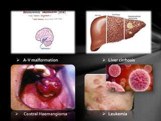  Liver cirrhosis A-V malformation
 Central Haemangioma  Leukemia
 