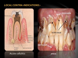 LOCAL CONTRA-INDICATIONS:-
Acute cellulitis ANUG
 