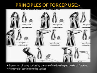 Expansion of bony socket by the use of wedge shaped beaks of forceps.
Removal of teeth from the socket
PRINCIPLES OF FORCEP USE:-
 