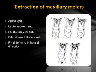 1. Apical grip.
2. Labial movement.
3. Palatal movement.
4. Dilatation of the socket.
5. Final delivery in buccal
direction.
Extraction of maxillary molars
 