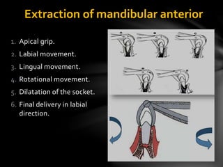 Extraction of mandibular anterior
1. Apical grip.
2. Labial movement.
3. Lingual movement.
4. Rotational movement.
5. Dilatation of the socket.
6. Final delivery in labial
direction.
 