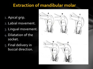 Extraction of mandibular molar
1. Apical grip.
2. Labial movement.
3. Lingual movement.
4. Dilatation of the
socket.
5. Final delivery in
buccal direction.
 