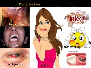 Post extraction
hematoma
trismus
ecchymosis pain
swelling
 