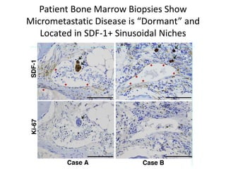 Patient Bone Marrow Biopsies Show
Micrometastatic Disease is “Dormant” and
Located in SDF-1+ Sinusoidal Niches
 