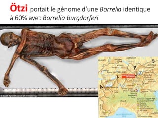 Ötzi portait le génome d’une Borrelia identique
à 60% avec Borrelia burgdorferi
 