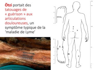 Ötzi portait des
tatouages de
« guérison » aux
articulations
douloureuses, un
symptôme typique de la
‘maladie de Lyme’
 