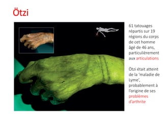 Ötzi
61 tatouages
répartis sur 19
régions du corps
de cet homme
âgé de 46 ans,
particulièrement
aux articulations
Ötzi était atteint
de la ‘maladie de
Lyme’,
probablement à
l’origine de ses
problèmes
d’arthrite
 