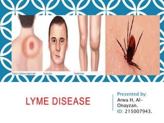 LYME DISEASE
Presented by:
Arwa H. Al-
Onayzan.
ID: 215007943.
 