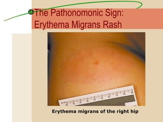 Erythema migrans of the right hip   The Pathonomonic Sign:  Erythema Migrans Rash 