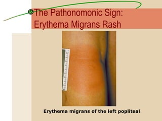 Erythema migrans of the left popliteal The Pathonomonic Sign:  Erythema Migrans Rash 