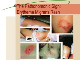 The Pathonomonic Sign:  Erythema Migrans Rash 