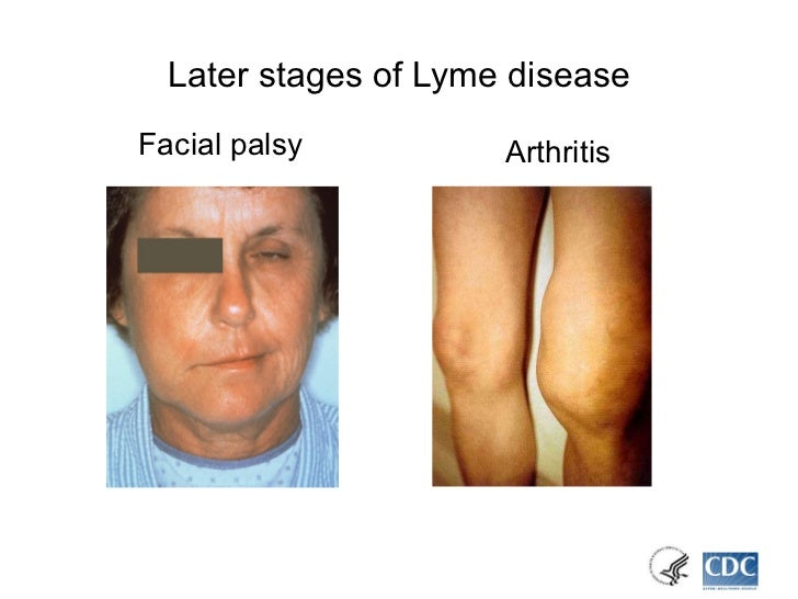 Lyme Disease Information