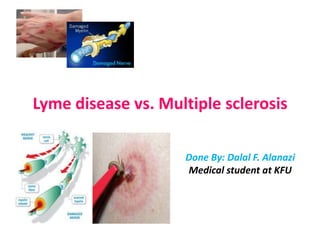 Lyme disease vs. Multiple sclerosis
Done By: Dalal F. Alanazi
Medical student at KFU
 