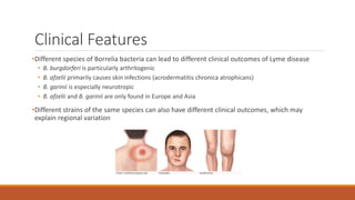 Clinical Features
•Different species of Borrelia bacteria can lead to different clinical outcomes of Lyme disease
• B. burgdorferi is particularly arthritogenic
• B. afzelii primarily causes skin infections (acrodermatitis chronica atrophicans)
• B. garinii is especially neurotropic
• B. afzelii and B. garinii are only found in Europe and Asia
•Different strains of the same species can also have different clinical outcomes, which may
explain regional variation
 