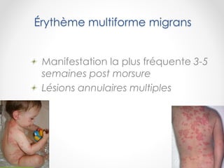 Érythème multiforme migrans
Manifestation la plus fréquente 3-5
semaines post morsure
Lésions annulaires multiples
 
