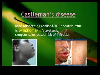 Castleman’s disease
Rare,idiopathic,Localised/multicentric,mim
ic lymphoma/HIV,systemic
symptoms,increased risk of infection
 
