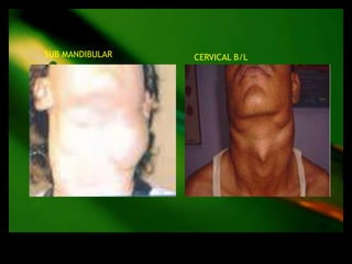 SUB MANDIBULAR   CERVICAL B/L
 