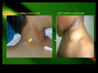 RIGHT SUPRA CLAVICULAR   LEFT SUPRA CLAVICULAR
 