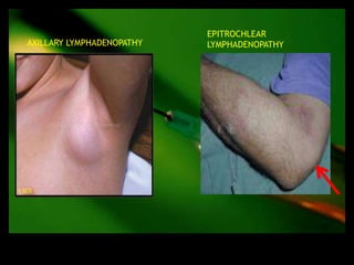 EPITROCHLEAR
AXILLARY LYMPHADENOPATHY   LYMPHADENOPATHY
 