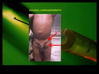INGUINAL LYMPHADENOPATHY
 