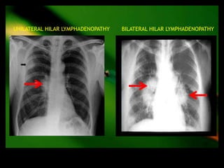 UNILATERAL HILAR LYMPHADENOPATHY   BILATERAL HILAR LYMPHADENOPATHY
 