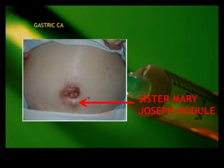 GASTRIC CA




             SISTER MARY
             JOSEPH NODULE
 