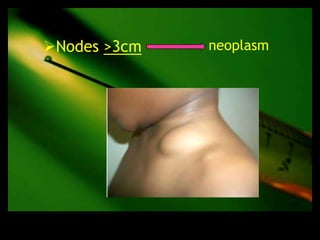 Nodes >3cm   neoplasm
 