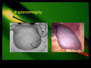 splenomegaly
 