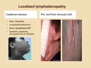 Localized lymphadenopathy
Castleman disease: Pre- and Post- Auricular LAD
 Rare, Idiopathic
 Localized/multicentric
 Mimic lymphoma/HIV
 Systemic symptoms,
increased risk of infection
 