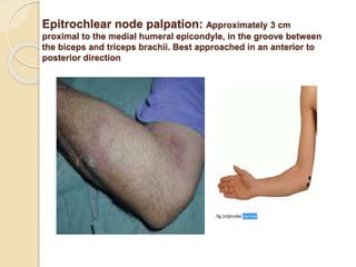 Epitrochlear node palpation: Approximately 3 cm
proximal to the medial humeral epicondyle, in the groove between
the biceps and triceps brachii. Best approached in an anterior to
posterior direction
 
