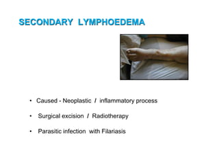 SECONDARY LYMPHOEDEMA
• Caused - Neoplastic / inflammatory process
• Surgical excision / Radiotherapy
• Parasitic infection with Filariasis
 