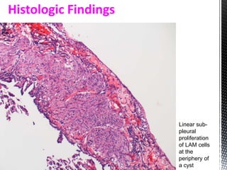 Histologic Findings
Linear sub-
pleural
proliferation
of LAM cells
at the
periphery of
a cyst
 