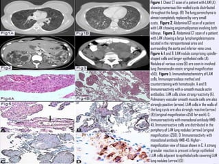 Figure 1. Chest CT scan of a patient with LAM (A)
showing numerous thin-walled cysts distributed
throughout the lungs. (B) The lung parenchyma is
almost completely replaced by very small
cysts. Figure 2. Abdominal CT scan of a patient
with LAM showing angiomyolipomas involving both
kidneys. Figure 3. Abdominal CT scan of a patient
with LAM showing a large lymphangioleiomyoma
located in the retroperitoneal area and
surrounding the aorta and inferior vena cava.
Figure 4 A and B. LAM nodule comprising spindle-
shaped cells and larger epithelioid cells (A).
Nodules of various sizes (B) are seen in involved
lung (hematoxylin-eosin; original magnification
x50). Figure 5. Immunohistochemistry of LAM
cells. Immunoperoxidase method and
counterstaining with hematoxylin. A and B:
Immunoreactivity with a-smooth muscle actin
antibodies. LAM cells show strong reactivity (A).
Pulmonary vascular smooth muscle cells are also
strongly positive (arrow). LAM cells in the walls of
the lung cysts are also strongly reactive (arrow)
(B) (original magnification x250 for each). C:
Immunoreactivity with monoclonal antibody HMB-
45. Immunoreactive cells are distributed in the
periphery of LAM lung nodules (arrow) (original
magnification x250). D: Immunoreactivity with
monoclonal antibody HMB-45. Higher-
magnification view of tissue shown in C. A strong
granular reaction is present in large epithelioid
LAM cells adjacent to epithelial cells covering LAM
lung nodules (arrow) (D)
 