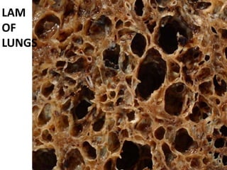 LAM
OF
LUNGS
 