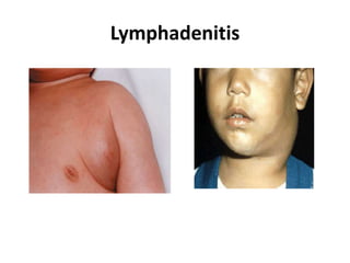 Lymphadenitis
 