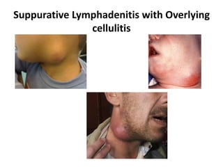 Suppurative Lymphadenitis with Overlying
cellulitis
 