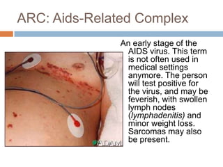 ARC: Aids-Related ComplexAn early stage of the AIDS virus. This term is not often used in medical settings anymore. The person will test positive for the virus, and may be feverish, with swollen lymph nodes (lymphadenitis) and minor weight loss. Sarcomas may also be present.