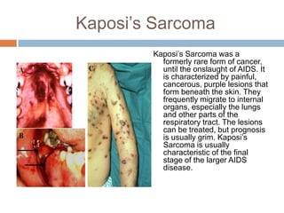 Kaposi’s SarcomaKaposi’s Sarcoma was a formerly rare form of cancer, until the onslaught of AIDS. It is characterized by painful, cancerous, purple lesions that form beneath the skin. They frequently migrate to internal organs, especially the lungs and other parts of the respiratory tract. The lesions can be treated, but prognosis is usually grim. Kaposi’s Sarcoma is usually characteristic of the final stage of the larger AIDS disease.