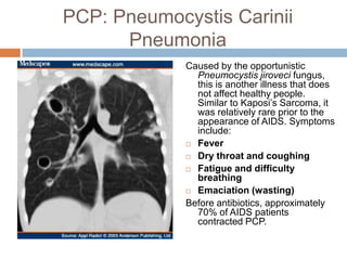 PCP: PneumocystisCarinii PneumoniaCaused by the opportunistic Pneumocystisjiroveci fungus, this is another illness that does not affect healthy people. Similar to Kaposi’s Sarcoma, it was relatively rare prior to the appearance of AIDS. Symptoms include:FeverDry throat and coughingFatigue and difficulty breathingEmaciation (wasting)Before antibiotics, approximately 70% of AIDS patients contracted PCP. 