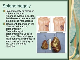 Splenomegaly Splenomegaly or enlarged spleen is another lymphatic system disorder, that develops due to a viral infection like monucleosis Treatment depends on the disease that lead to splenomegaly. Chemotherapy in splenomegaly is used in the case of hematological malignancies, antibiotics in infections, and surgery in the case of splenic abscess.  