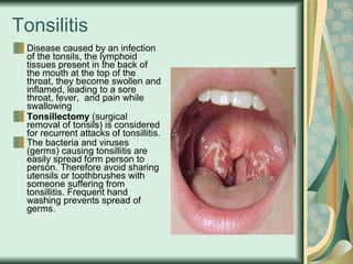 Tonsilitis Disease caused by an infection of the tonsils, the lymphoid tissues present in the back of the mouth at the top of the throat, they become swollen and inflamed, leading to a sore throat, fever,  and pain while swallowing   Tonsillectomy  (surgical removal of tonsils) is considered for recurrent attacks of tonsillitis. The bacteria and viruses (germs) causing tonsillitis are easily spread form person to person. Therefore avoid sharing utensils or toothbrushes with someone suffering from tonsillitis. Frequent hand washing prevents spread of germs. 