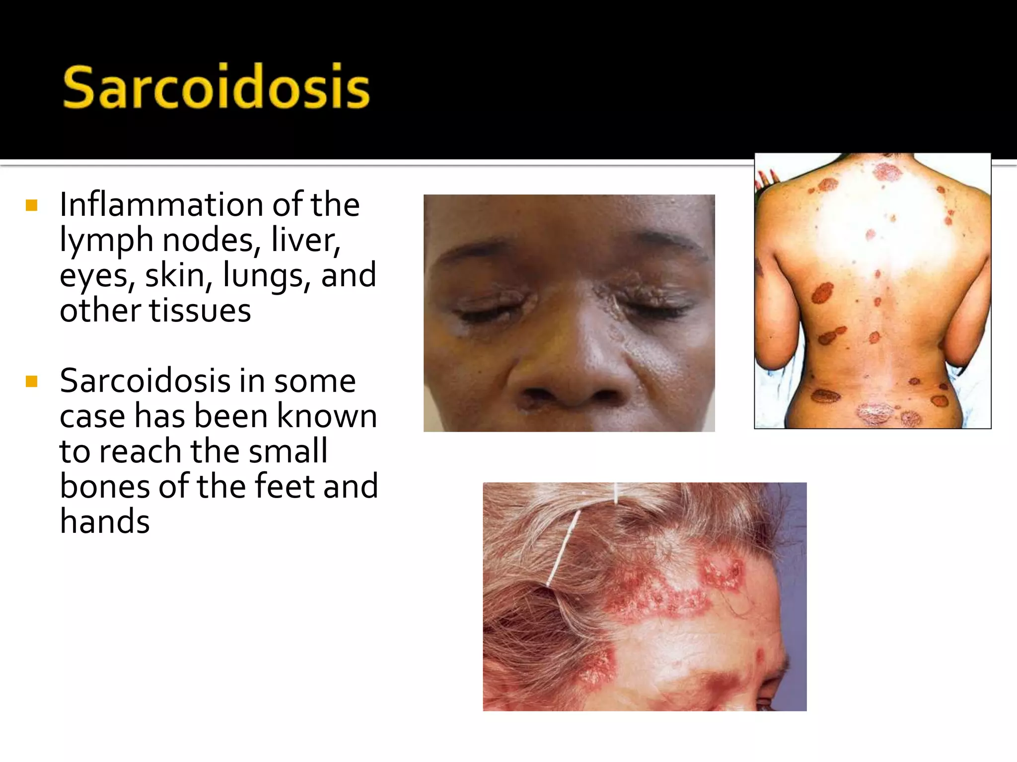 Sarcoidosis Inflammation of the lymph nodes, liver, eyes, skin, lungs, and other tissuesSarcoidosis in some case has been known to reach the small bones of the feet and hands 