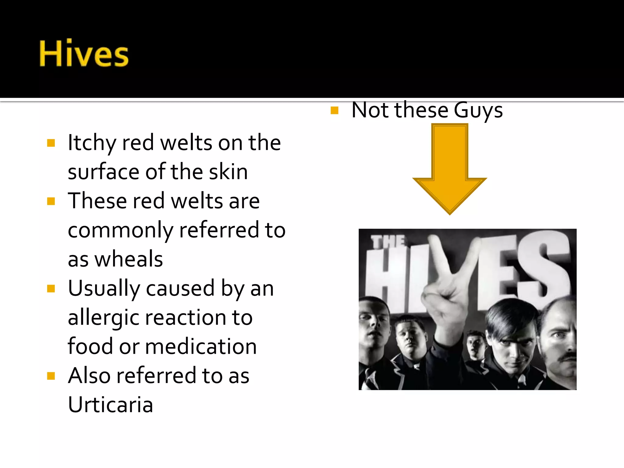 Hives Itchy red welts on the surface of the skinThese red welts are commonly referred to as whealsUsually caused by an allergic reaction to food or medication Also referred to as Urticaria  Not these Guys 