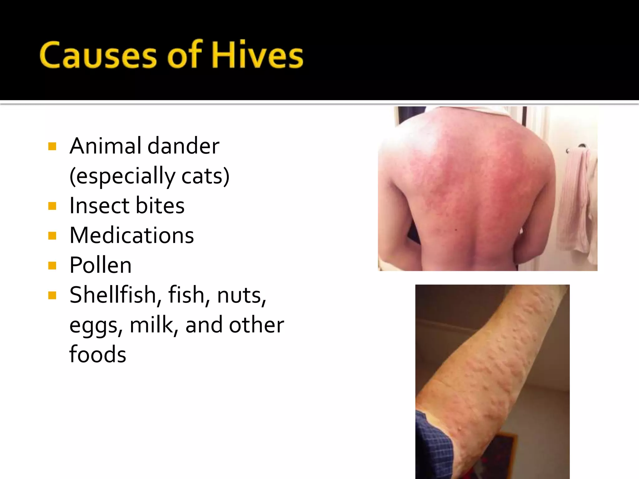 Causes of Hives Animal dander (especially cats)Insect bitesMedicationsPollenShellfish, fish, nuts, eggs, milk, and other foods